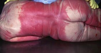 Pinkish-red discoloration of the skin of a victim of CO poisoning