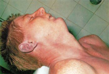 Pinkish discoloration of the skin of a victim of cyanide poisoning by ingesting calcium cyanide.